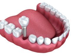 single tooth dental implant marietta ga