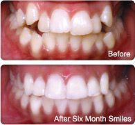Six Month Smiles before and after