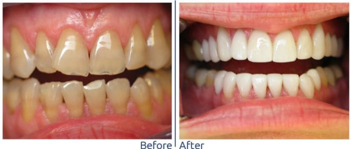 Before and after Restorative Dentistry in Marietta GA