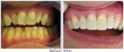 KOR Teeth Whitening Deep Teeth Bleaching before and after