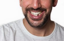 Replace Your Missing Teeth With Dental Implants