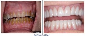 Restorative dentistry in Marietta Georgia