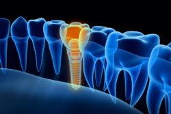 dental implants benefits in Marietta Georgia