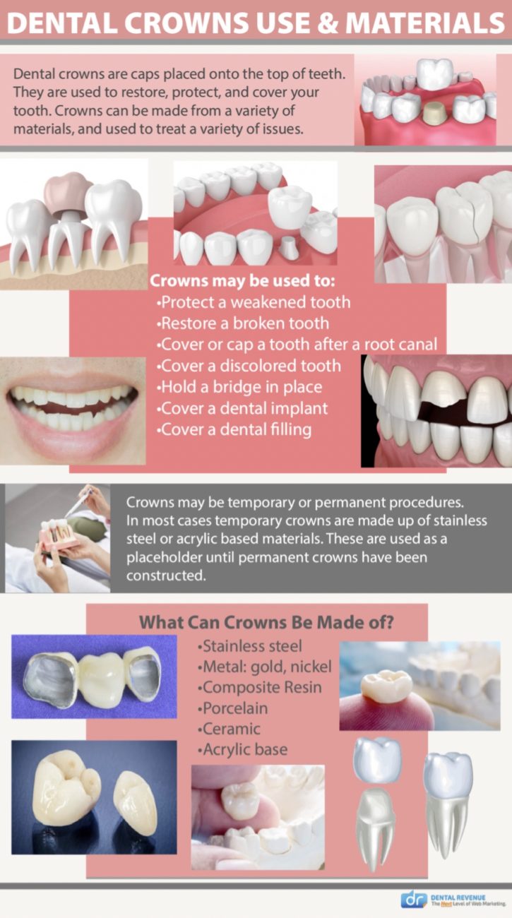 Dental crown use and materials infographic