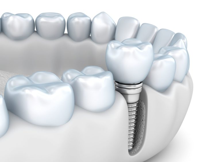 implant dentistry Marietta Georgia