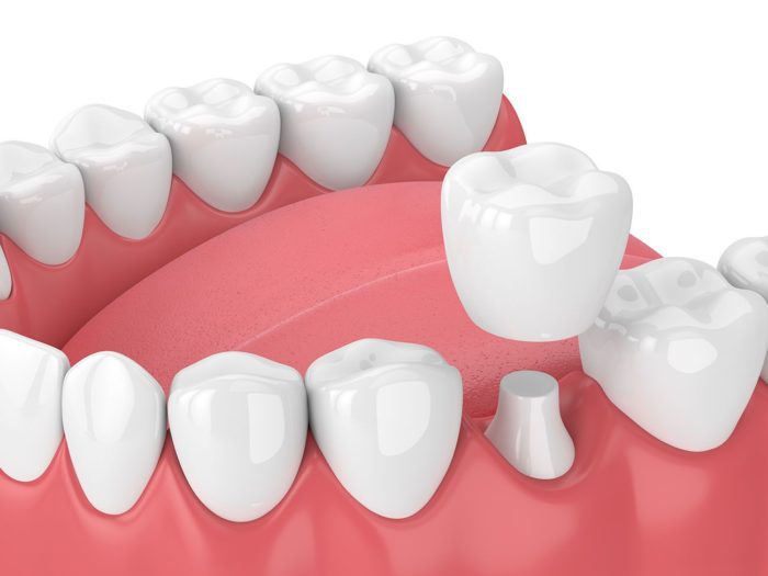 dental crown benefits Marietta Georgia