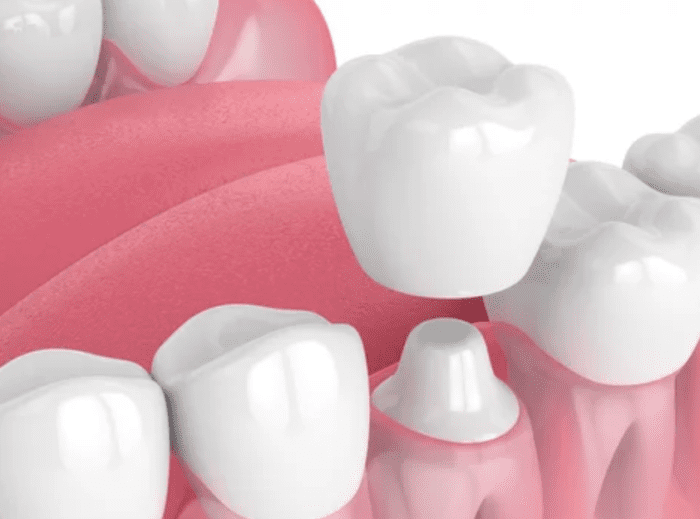 3D render of a dental crown being placed on a tooth restorative dentistry dentist in Marietta Georgia